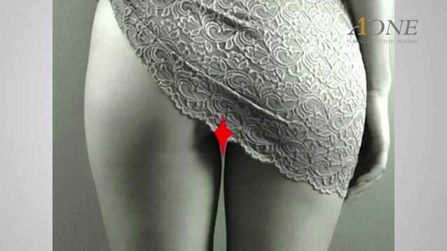 [혐⚠️주의] 지방흡입수술 4V _ 실제수술장면    4